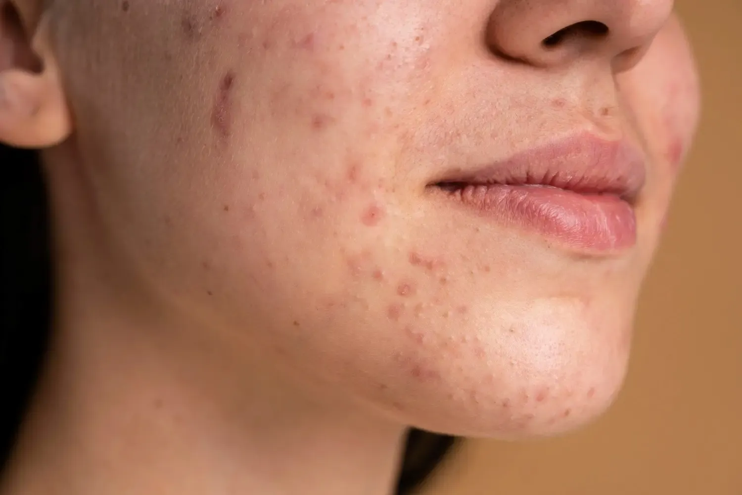 manchas-post-acne.webp